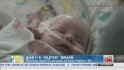Surgical superglue saves baby's life