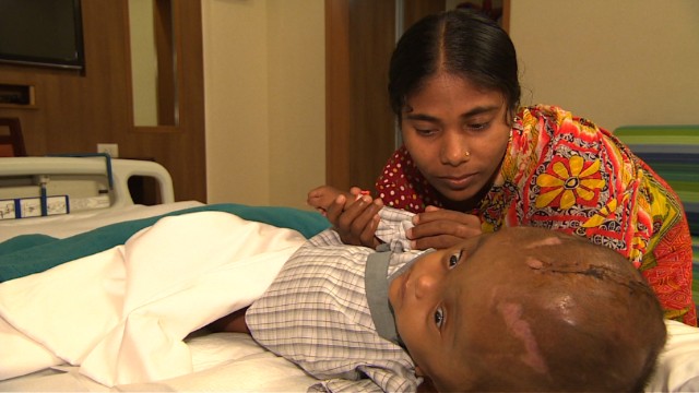 Before Roona underwent several surgeries to reduce the swelling, the skin of her head was stretched so far that it pulled her eyelids over her eyes, making it impossible for her to see. 