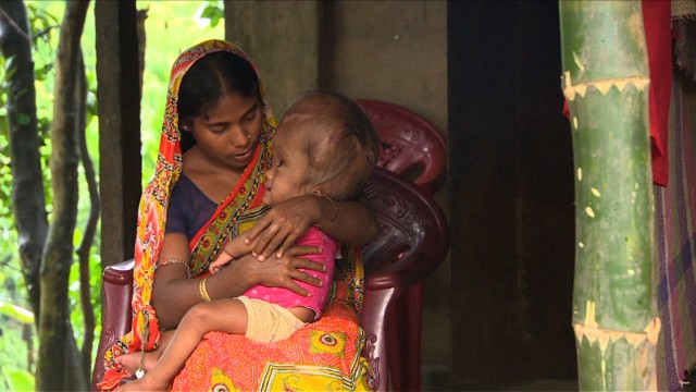 After five high-risk surgeries, Roona pulled through and her head is now down to a circumference of 58 cm. She can now move her head around, she is more playful and most importantly, she can see. 