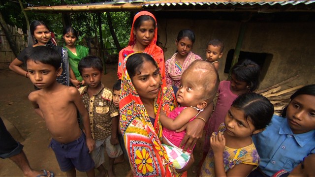 Back in her village, Roona has become the center of attention. Its too early to tell if she will ever be completely normal -- several operations still lie ahead, but the signs so far are promising. 