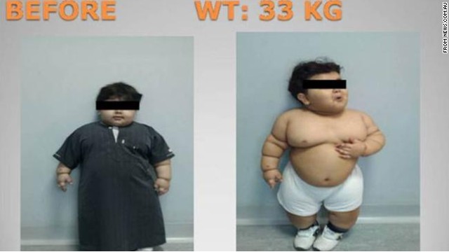 The two-year-old Saudi patient is seen here before bariatric surgery to reduce his weight.
