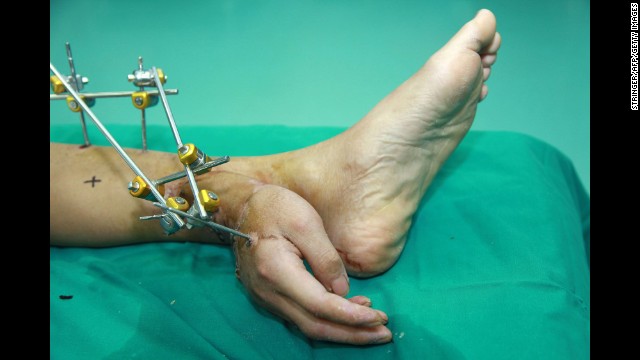 Doctors grafted Xiao Wei's right hand to his ankle, then reattached it after his arm healed. 