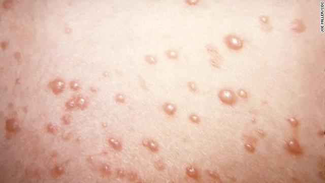 Does shingles occur in children?