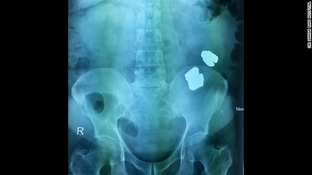 "We couldn't (either) make out they were gold bars," the doctor said. "But yes, X-Rays showed there was intestinal blockage, which required surgery."