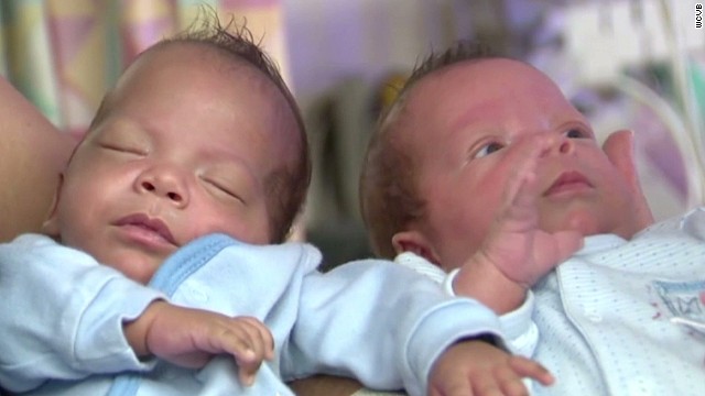 Gemelos idénticos nacen con una diferencia de... 24 días