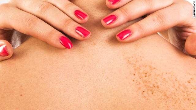 Moles may predict breast cancer risk