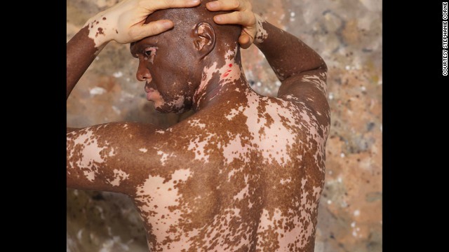 Lee Thomas, pictured, said vitiligo challenged his personal identity as an African-American man. Darkness is a sign of strength, he said, and it was a process to acknowledge that he didn't lose his identity. "Color has nothing to do with the integrity of who I am," Thomas said.