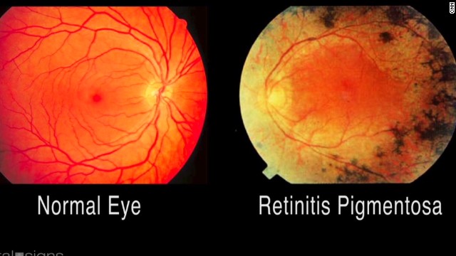 vision loss normal lens normal retina