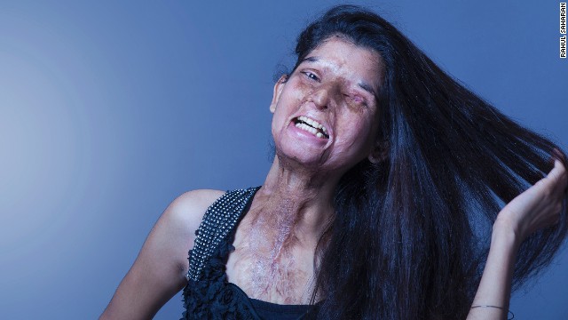 Ritu lost vision in her left eye 15 days after she was attacked.