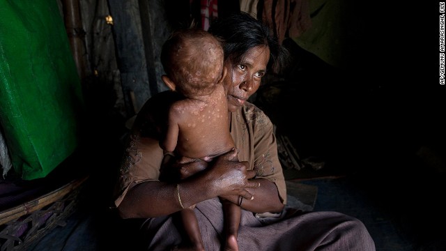 A Rohingya refugee holds her daughter who suffers from a skin disease at Dar Paing camp, Rakhine, Myanmar.