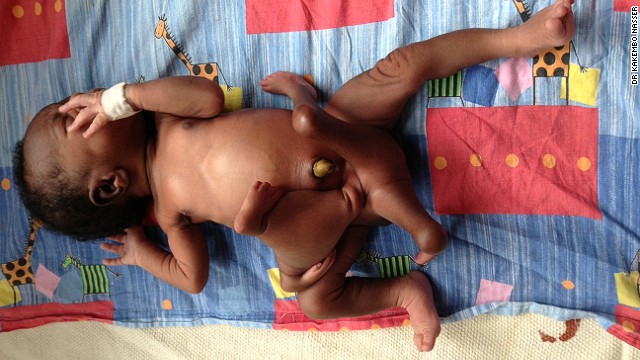 Baby Paul Mukisa was born with a "parasitic twin," a conjoined twin that did not fully develop.