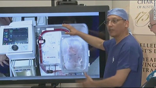 Hospital transplanta con éxito corazones "muertos"