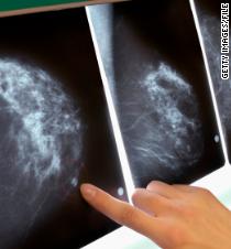 New Late-stage Breast Cancer Treatment Approved - CNN.com