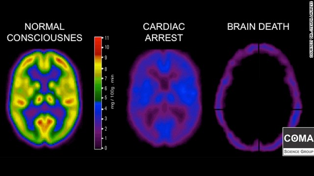 Eeg Of A Brain Dead Person