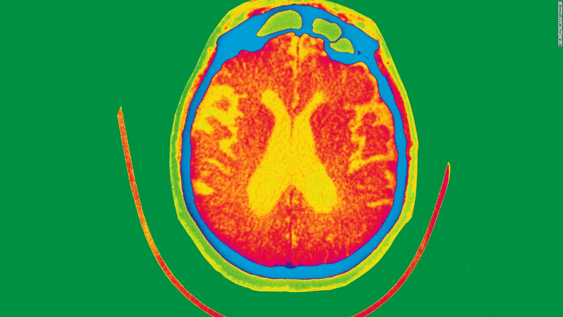 Air Pollution Particles Found Inside Human Brains