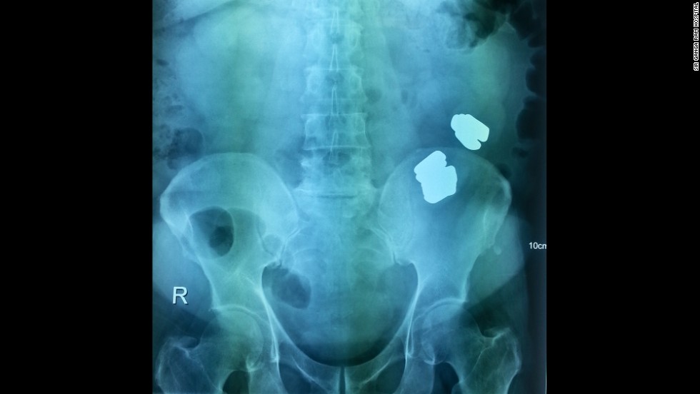 Indian Surgeons Find 12 Gold Bars In Mans Stomach