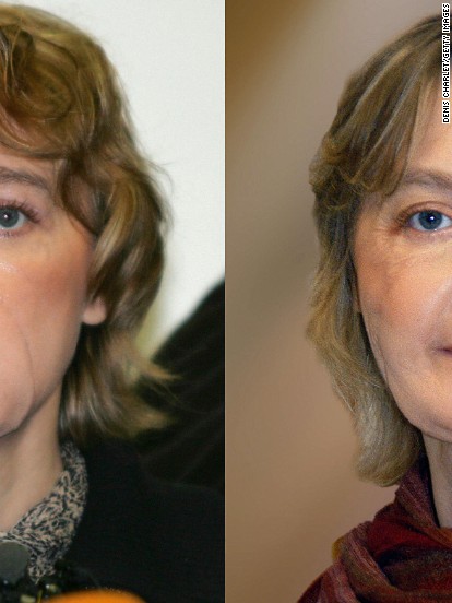 Facial first picture transplant