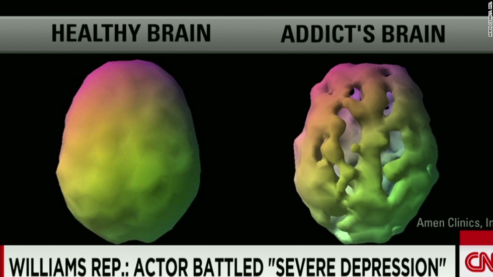 A healthy brain and an addict&#39;s brain will look different using a brain scan. A healthy brain will show even blood flow and activity, an addicts brain would show more problems on a scan.