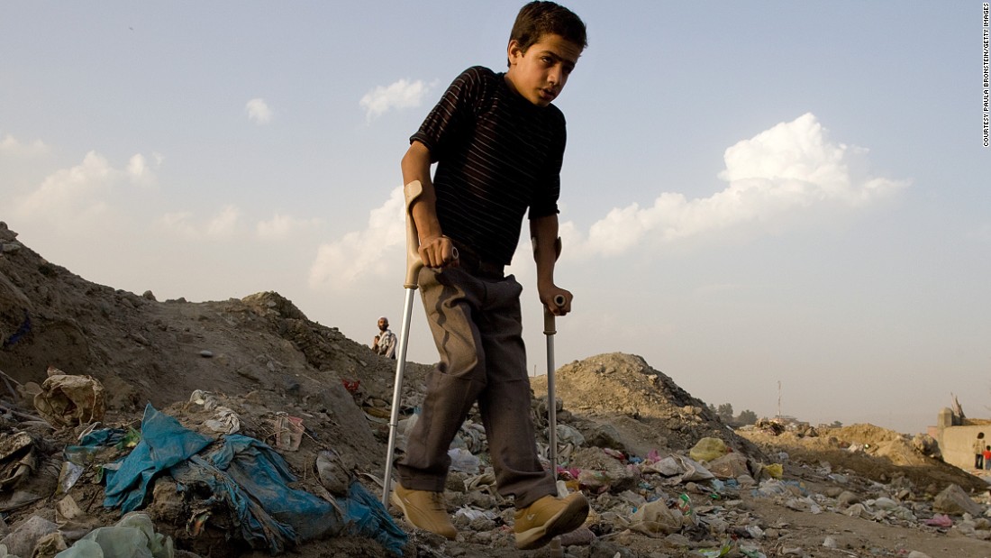 Leprosy, plague, gout -- diseases that many have forgotten, but are by no means gone. Pictured, a boy with polio.