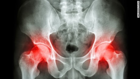 Film x-ray pelvis of osteoporosis patient and arthritis both hip