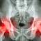 Film x-ray pelvis of osteoporosis patient and arthritis both hip