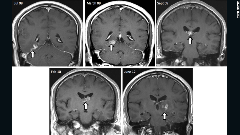 After four years, the British patient returned to hospital in pain to find his brain lesion had migrated to a new region of the brain resulting in new symptoms, including seizures. His MRI scans show the tapeworm's burrowed migration through the brain over four years.