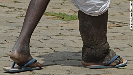 The race to eliminate Elephantiasis in India