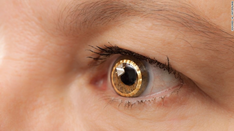 Swiss biotech firm Sensimed was an early adopter of smart lens technology, to monitor the progression of glaucoma. Its "Triggerfish" system comprised a lens and a wireless data receiver worn around the neck, designed to monitor the eye over 24 hours. The technology is hoped to enable earlier diagnosis.