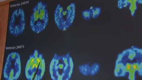 Could veterans have concussion-related CTE?