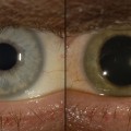 When the Ebola virus was found in Dr. Ian Crozier's eye, the eye started losing its original blue hue, he told the New York Times. 