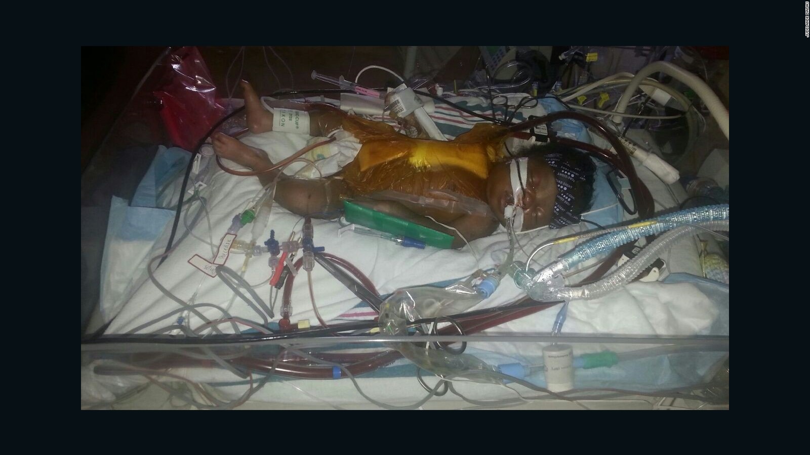 From 2011 to 2015, nine babies died after heart surgery at St. Mary's Medical Center in Florida. This baby, Jashnide Desamours, went in organ failure after surgery there, but was transferred to another hospital and survived.