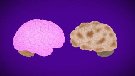 How Alzheimer's destroys the brain - CNN Video