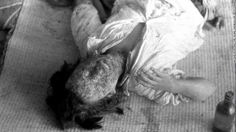 A patient suffering severe radiation burns lies in the Hiroshima Red Cross hospital in August 1945. Many of those who survived the initial blast on August 6 died of severe radiation-related injuries and illnesses. 