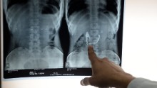 Discovered accidentally by German physicist Wilhelm Conrad Röntgen, X-rays allowed doctors to see inside the human body for the first time without the use of surgery. They were used during the Balkan War to locate bullets and broken bones in patients. While doctors and scientists were eager to use X-ray technology, they didn't understand how strong the effects of radiation could be. In 1904, Thomas Edison's assistant, who worked with X-rays daily, died of skin cancer. Today, the technology is widely used.