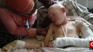 Albino teen attacked for her body parts
