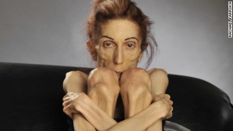 40-Pound Anorexic Woman Undergoes Dramatic Transformation