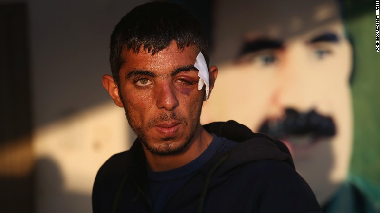 A wounded YPG soldier recovers at a center for injured troops on November 9 in northern Syria. 