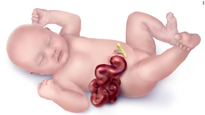  CDC researchers say there&#39;s an increase in the birth defect gastroschisis, which can cause the intestines to poke through a newborn&#39;s abdomen.