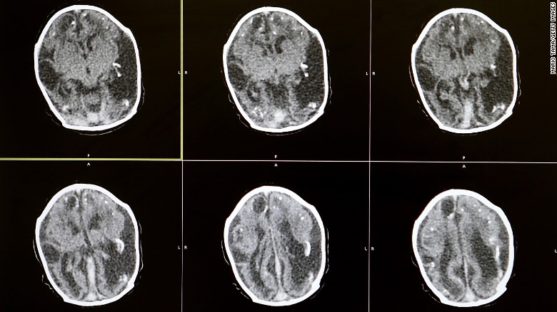 Brain scans of a 2-month-old baby with microcephaly are displayed in Recife on January 27 by Dr. Vanessa Van Der Linden, the neuro-pediatrician who first recognized and alerted authorities of the microcephaly crisis in Brazil. The baby&#39;s mother was diagnosed with having the Zika virus during her pregnancy.