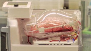 TransMedics device keeps organs alive outside the body