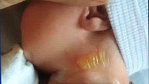 newborn baby burned hospital infant warmer screw pkg_00014004.jpg