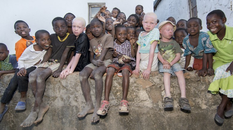 Criminal gangs hunt albinos to kill and dismember them, selling their bones. 