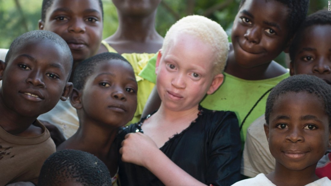 Hunting For Humans African Albinos Live In Fear 