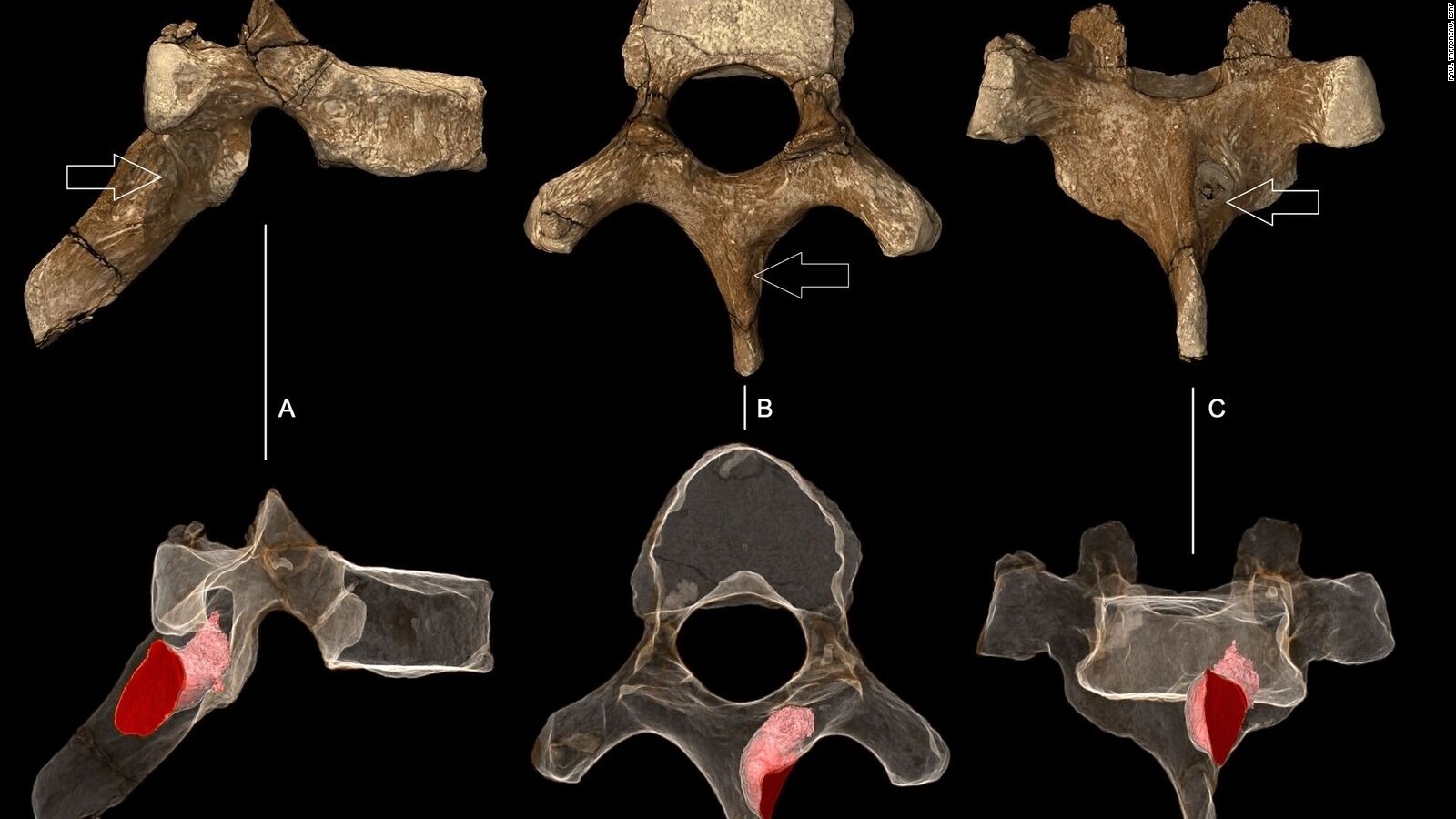 An ancient vertebra, with the outline of the tumor rendered in pink.