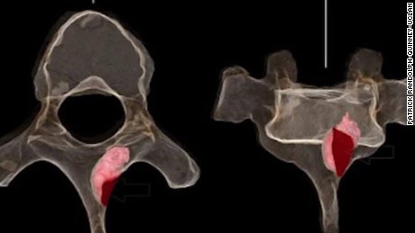Cancer found in million-year-old fossil