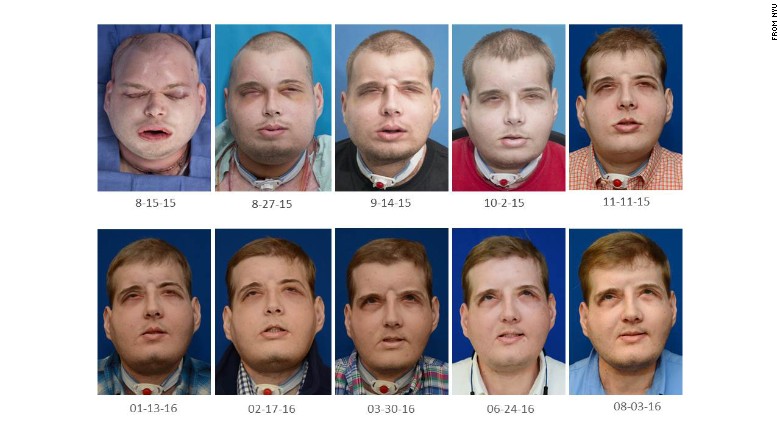 Firefighter and face transplant recipient Patrick Hardison&#39;s face has recovered with no rejection episodes.