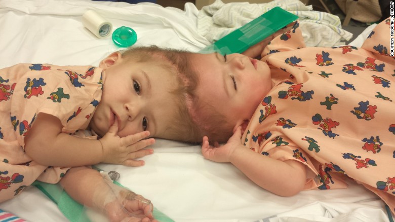 New Life: Rare Surgery to Separate Conjoined Twins