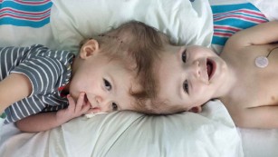 New life, apart: Brothers conjoined at head are in surgery
