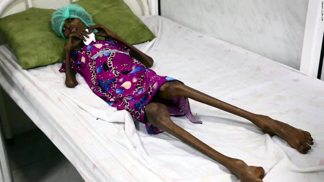 Severely malnourished woman fights to survive
