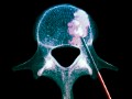Bad to the bone: A medical horror story